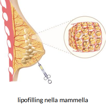 lipoffiling mammella